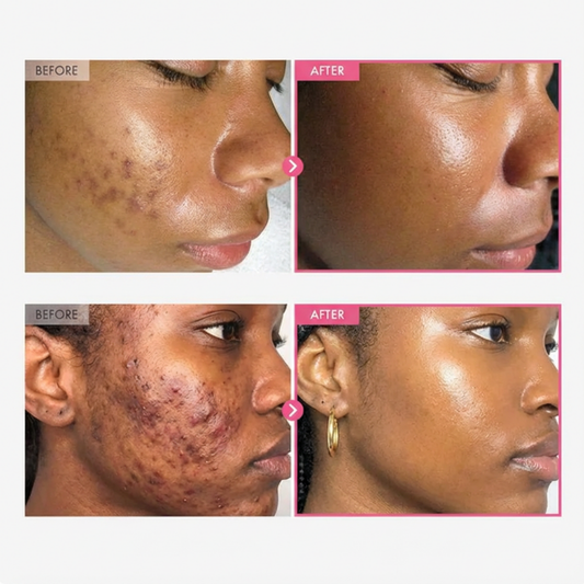 SEORA™ Alpha Arbutin + TXA Cream - Arbutin 7% + Tranexamic Acid 4% Cream