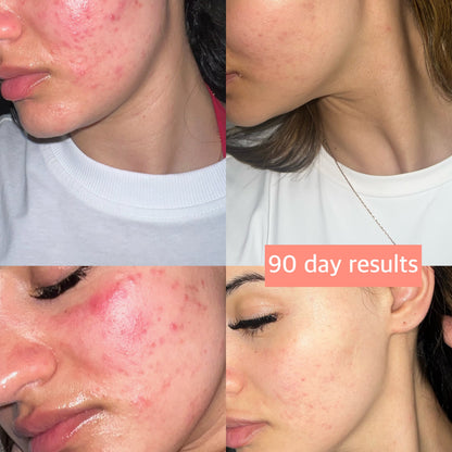RadiancePro™ LED Photon Therapy Face Mask